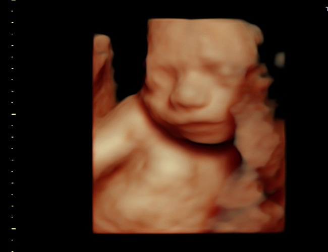 3D ultrasound image at 25 weeks